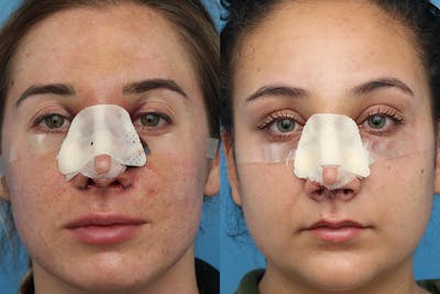 No bruise Rhinoplasty – One day Post-operative Before & After Gallery - Patient 6276416 - Image 1
