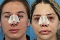 No bruise Rhinoplasty – One day Post-operative Before & After Gallery - Patient 6276417 - Image 1