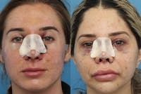 No bruise Rhinoplasty – One day Post-operative Gallery - Patient 6276417 - Image 1
