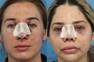 No bruise Rhinoplasty – One day Post-operative Before & After Gallery - Patient 6276417 - Image 1