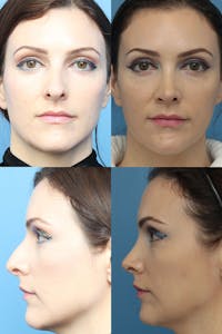 Female Bulbous Tip Before & After Gallery - Patient 7510344 - Image 1