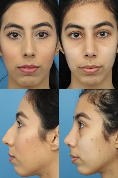 Female Dorsal Hump Before & After Gallery - Patient 7575919 - Image 1