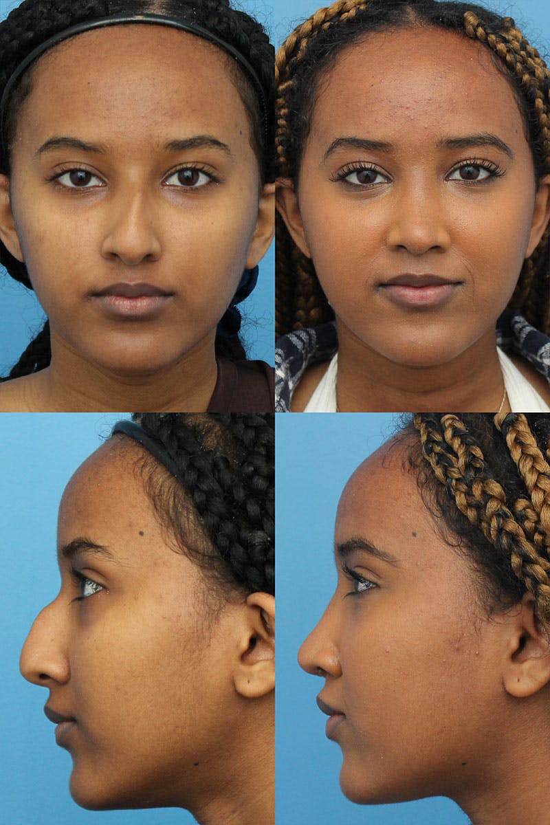 Female Dorsal Hump Before & After Gallery - Patient 5468575 - Image 1