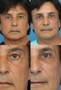 Lower Blepharoplasty Photo Gallery Before & After Gallery - Patient 2388461 - Image 1