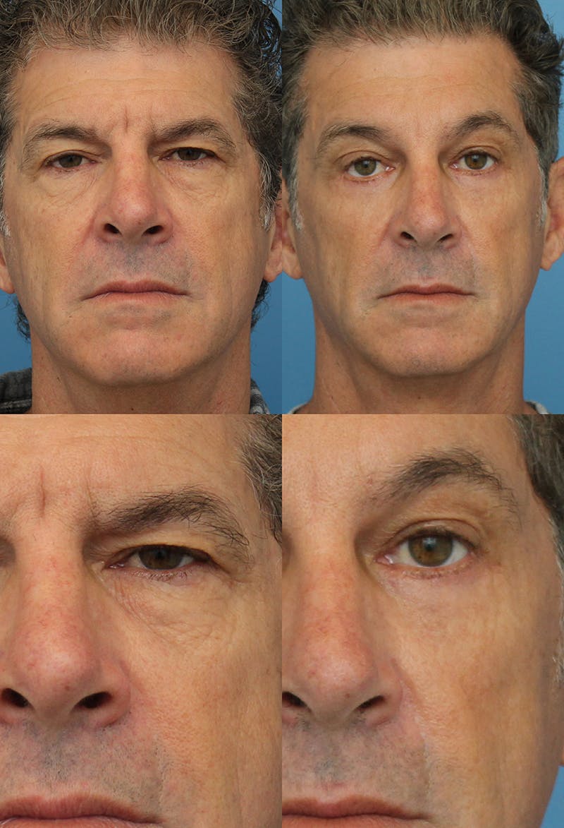 Brow Lift Before & After Gallery - Patient 8821227 - Image 1