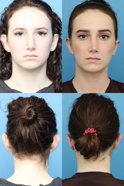 Facelift Before and After  Ranch & Coast Plastic Surgery