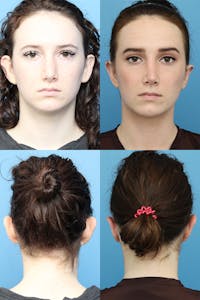 Dr. Chasan Otoplasty Before & After Gallery - Patient 10840109 - Image 1
