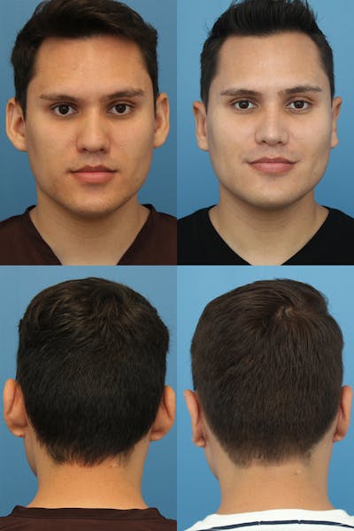 Dr. Chasan Otoplasty Before & After Gallery - Patient 10840110 - Image 1