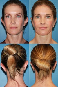 Dr. Chasan Otoplasty Before & After Gallery - Patient 10840111 - Image 1