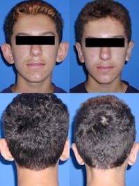 Dr. Chasan Otoplasty Before & After Gallery - Patient 10840112 - Image 1