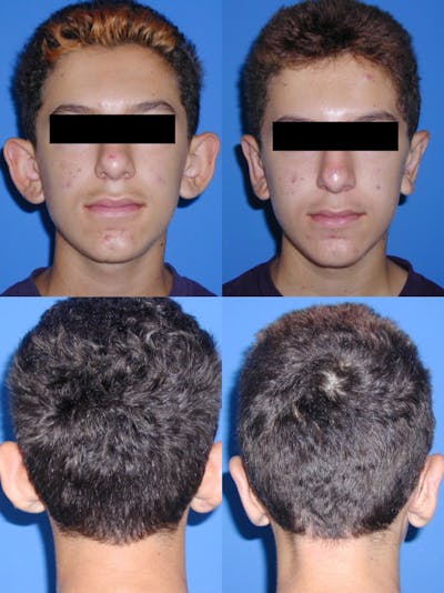 Dr. Chasan Otoplasty Before & After Gallery - Patient 10840112 - Image 1