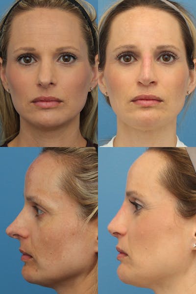 Female Revision Rhinoplasty Before & After Gallery - Patient 10840167 - Image 1