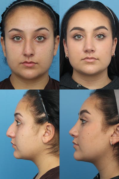 Female Drooping Tip Before & After Gallery - Patient 11269997 - Image 1