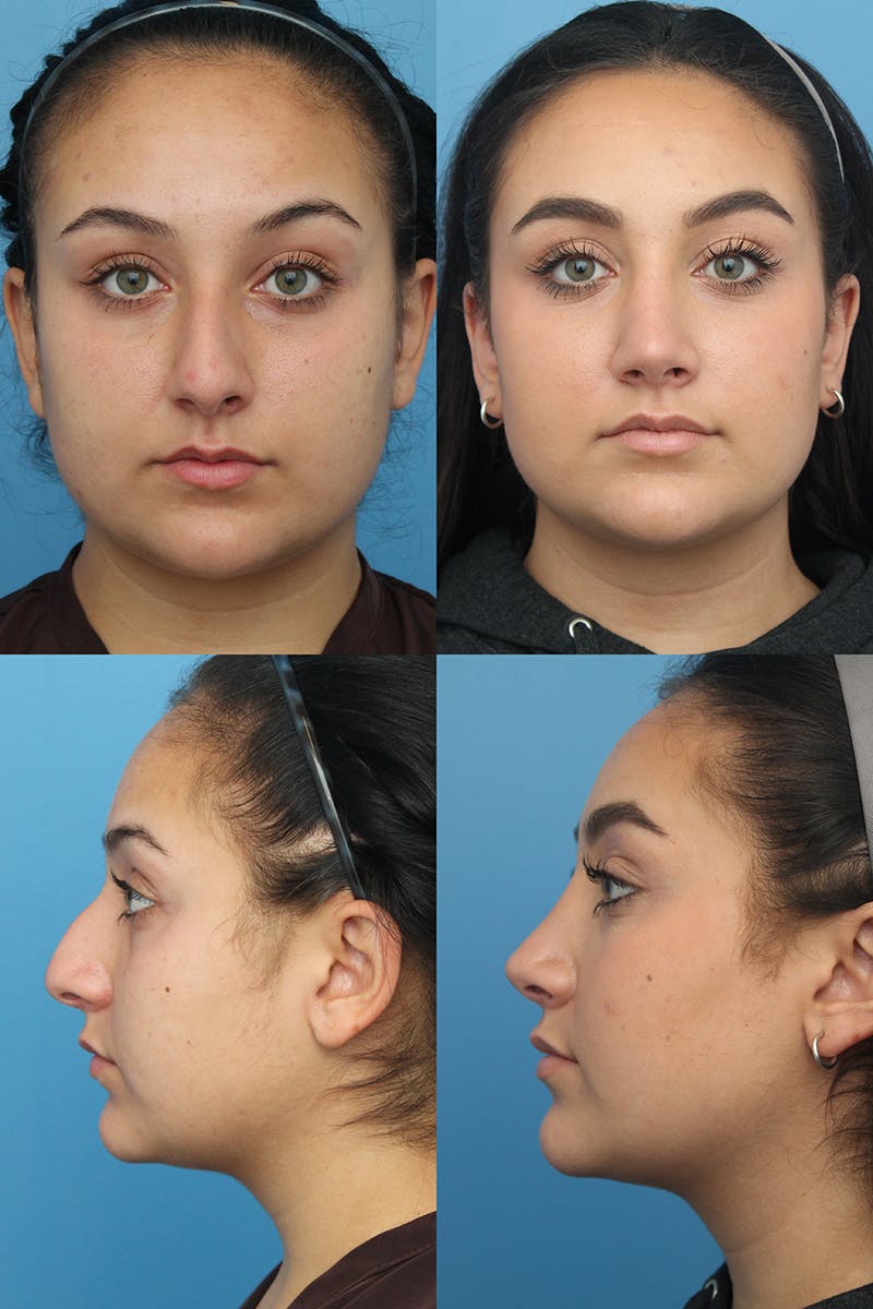 Female Drooping Tip Before & After Gallery - Patient 11269997 - Image 1