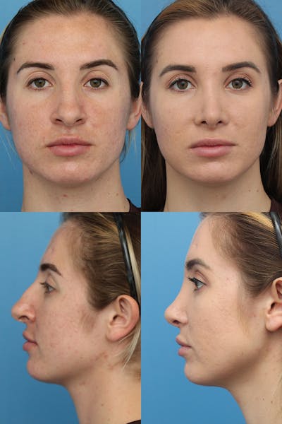 Female Prominent Nostril / Hanging Columella Before & After Gallery - Patient 13899191 - Image 1