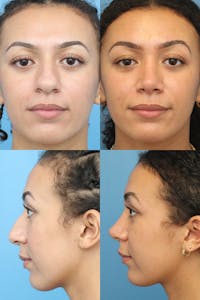 Female Dorsal Hump Before & After Gallery - Patient 13899270 - Image 1