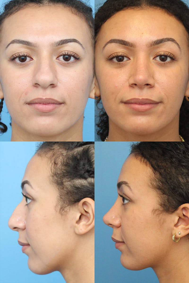 Female Drooping Tip Before & After Gallery - Patient 13899430 - Image 1