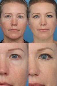 Lower Blepharoplasty Photo Gallery Before & After Gallery - Patient 13899463 - Image 1