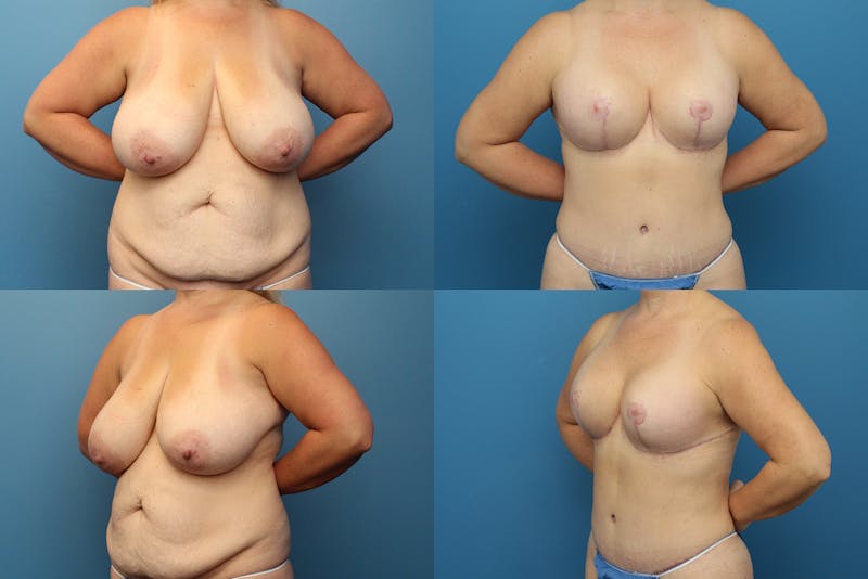 Reductive Augmentation of the Breast Before & After Gallery - Patient 15176063 - Image 1
