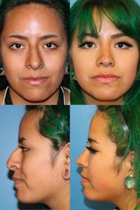 Female Prominent Nostril / Hanging Columella Before & After Gallery - Patient 17927068 - Image 1