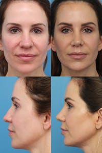 Female Drooping Tip Before & After Gallery - Patient 24216758 - Image 1