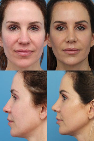 Female Drooping Tip Before & After Gallery - Patient 24216758 - Image 1
