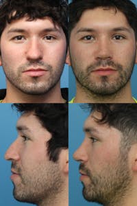 Male Rhinoplasty Before & After Gallery - Patient 24222776 - Image 1