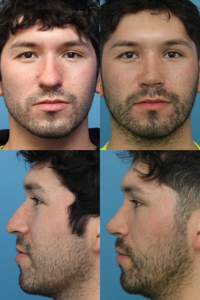 Male Rhinoplasty Before & After Gallery - Patient 24222776 - Image 1