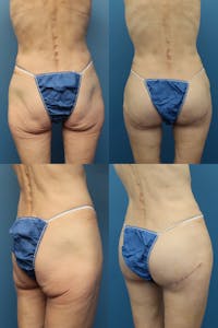 Thong Lift / Infragluteal Thigh Lift  Before & After Gallery - Patient 203085 - Image 1