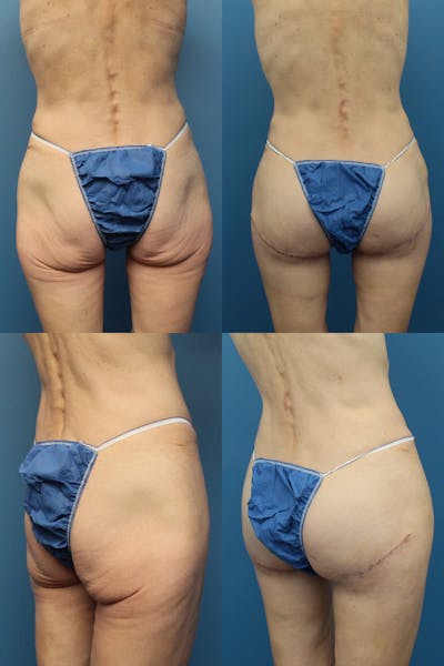 Thong Lift / Infragluteal Thigh Lift  Before & After Gallery - Patient 203085 - Image 1