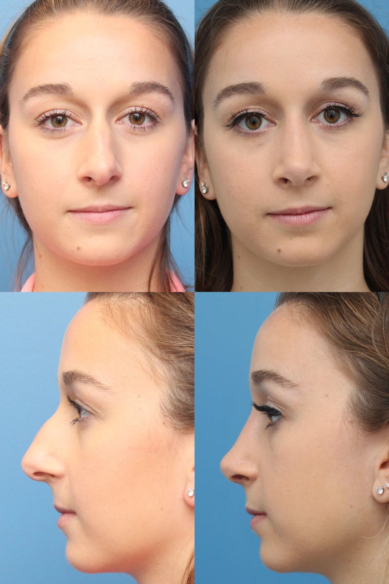 Female Bulbous Tip Before & After Gallery - Patient 26332632 - Image 1
