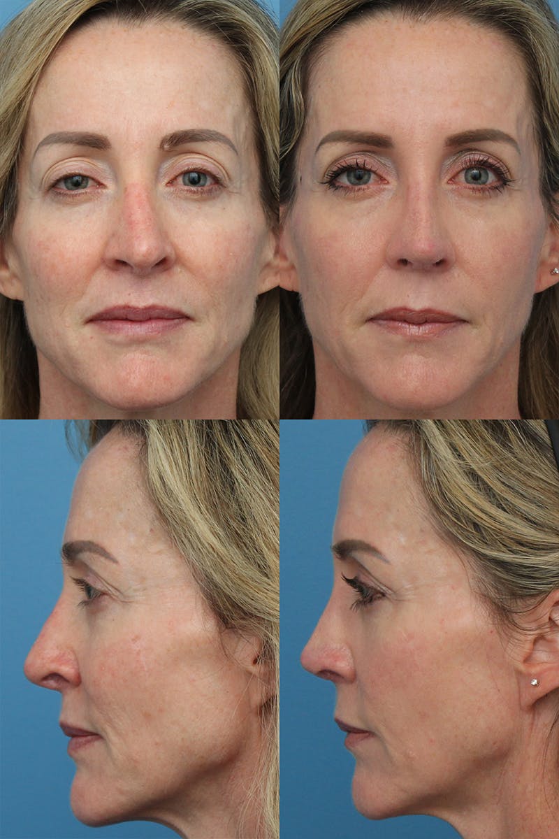 Crooked Nose Before & After Gallery - Patient 31357286 - Image 1