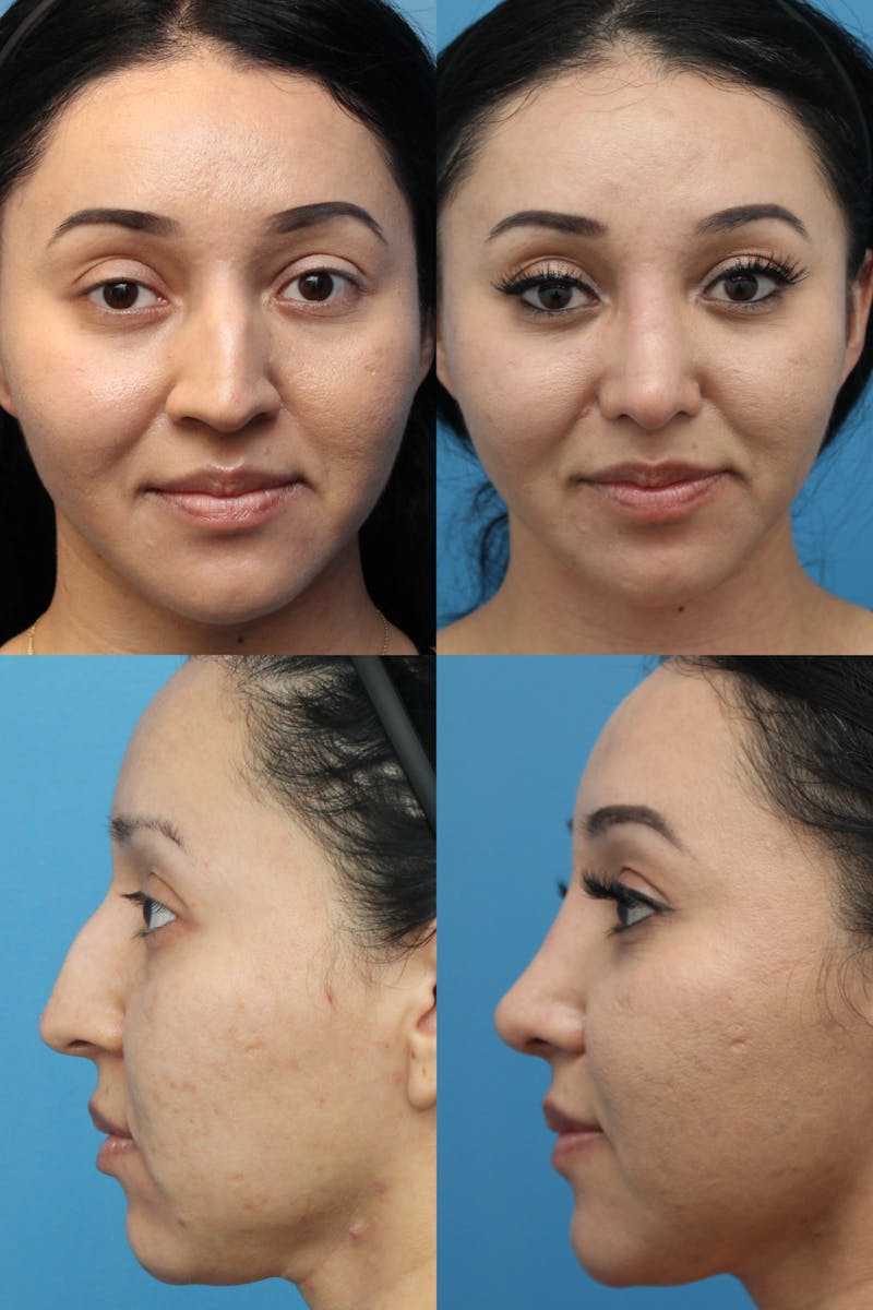 Crooked Nose Before & After Gallery - Patient 25734140 - Image 1