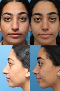 Female Bulbous Tip Before & After Gallery - Patient 40743383 - Image 1