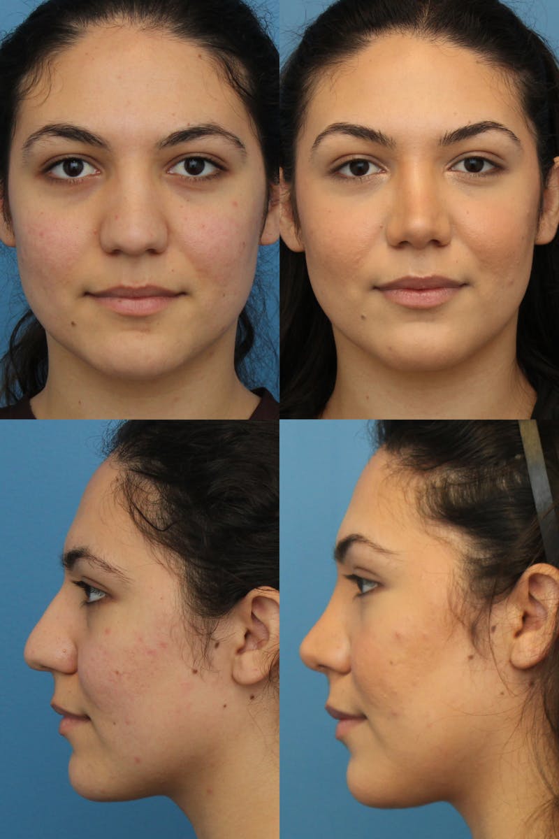Thick Skin / Ethnic Rhinoplasty Before & After Gallery - Patient 41619191 - Image 1
