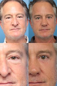 Upper Blepharoplasty Photo Gallery Before & After Gallery - Patient 146165737 - Image 1