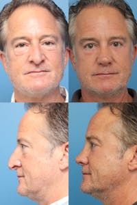 Male Rhinoplasty Before & After Gallery - Patient 47774142 - Image 1