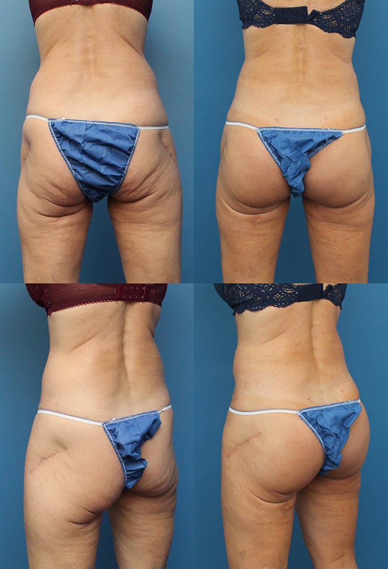 Buttock Augmentation with Implants Before & After Gallery - Patient 48813729 - Image 1