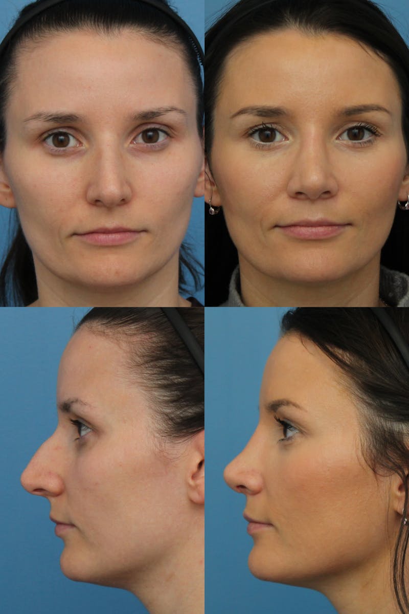 Rhinoplasty Before & After Gallery - Patient 67807365 - Image 1