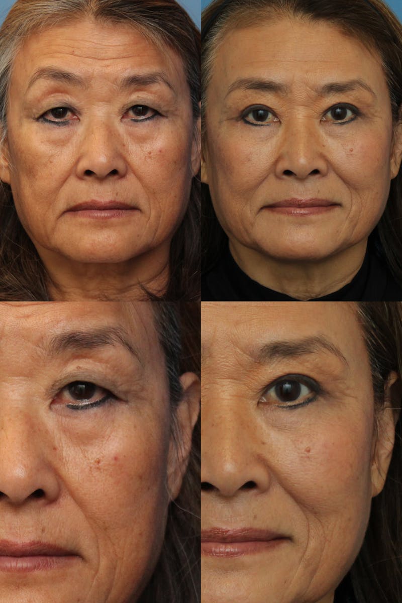 Upper Blepharoplasty Photo Gallery Before & After Gallery - Patient 71230661 - Image 1