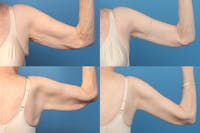 Arm Lift Before & After Gallery - Patient 71233608 - Image 1