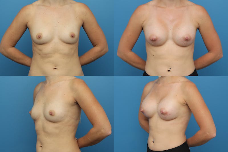 Small C Natural Shape Breast Gallery - Patient 71233770 - Image 1