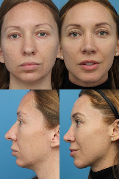Rhinoplasty Before & After Gallery - Patient 72743431 - Image 1