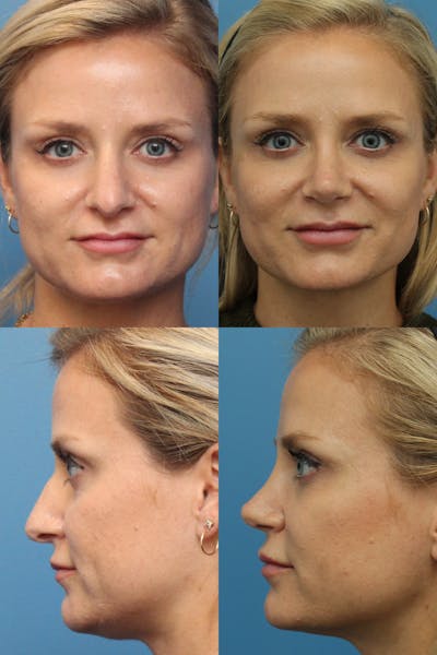 Rhinoplasty Before & After Gallery - Patient 73999183 - Image 1