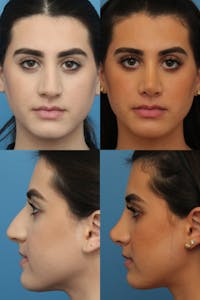 Rhinoplasty Before & After Gallery - Patient 73999184 - Image 1