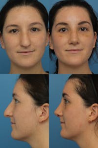 Female Drooping Tip Before & After Gallery - Patient 74002655 - Image 1