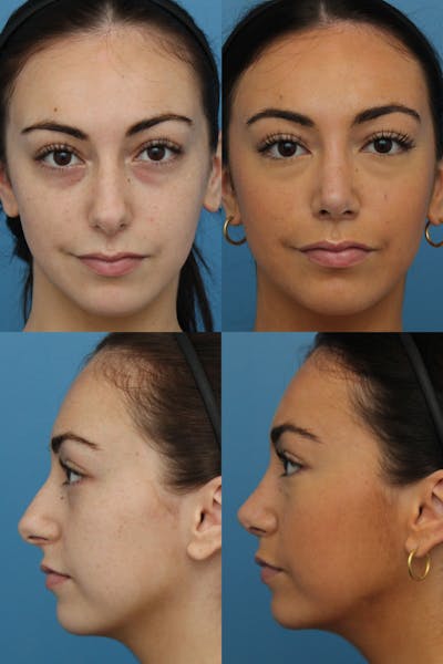 Female Prominent Nostril / Hanging Columella Before & After Gallery - Patient 74002660 - Image 1