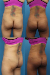 Brazilian Butt Lift Before & After Gallery - Patient 74007903 - Image 1