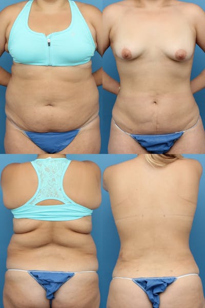Liposuction Before & After Gallery - Patient 74008057 - Image 1