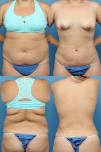 Liposuction: Female Before & After Gallery - Patient 74008096 - Image 1